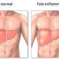 Foie normal foie enflamme