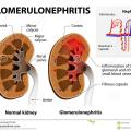 Glomerulonephrite ou nephrite glomerulaire maladie renale 65770360